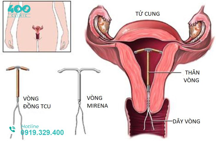 Vị trí vòng tránh thai được đặt trong tử cung