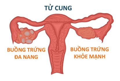 Buồng trứng đa nang cũng là một nguyên nhân gây vô sinh ở nữ giới