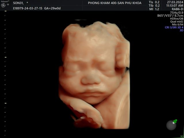 Hình ảnh em bé siêu âm 6D