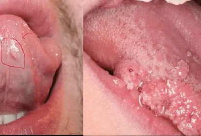 Bệnh sùi mào là một trong những bệnh lây qua đường tình dục thường gặp nhất