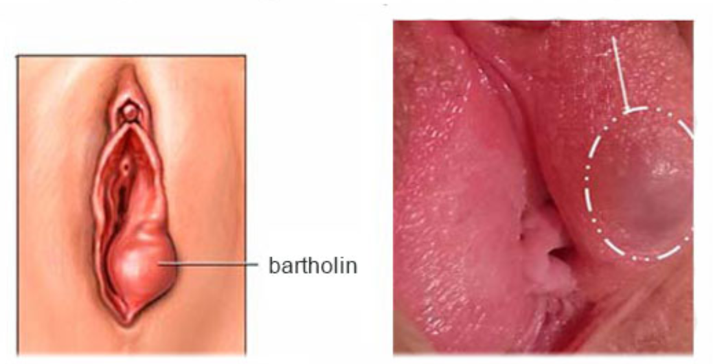 Triệu chứng của áp xe tuyến Bartholin