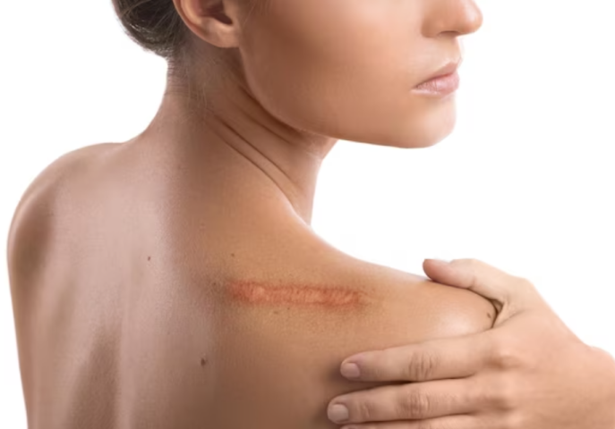 Sẹo lồi thường gây mất thẩm mỹ cho làn da của bạn