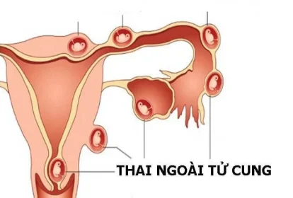 Chửa ngoài tử cung xử lý như thế nào