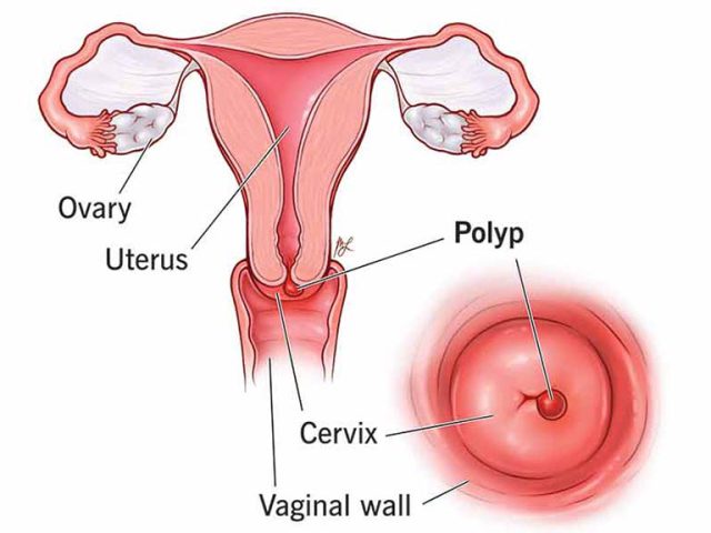 Phụ nữ có thể có một hoặc đa polyp trong lòng tử cung