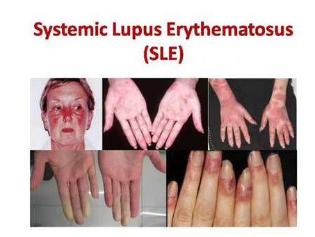 Biểu hiện của lupus ban đỏ thể hiện ở nhiều cơ quan.
