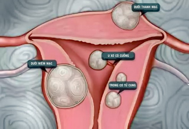 Phụ nữ mắc nhân xơ tử cung cần thực hiện kỹ thuật siêu âm bơm nước buồng tử cung