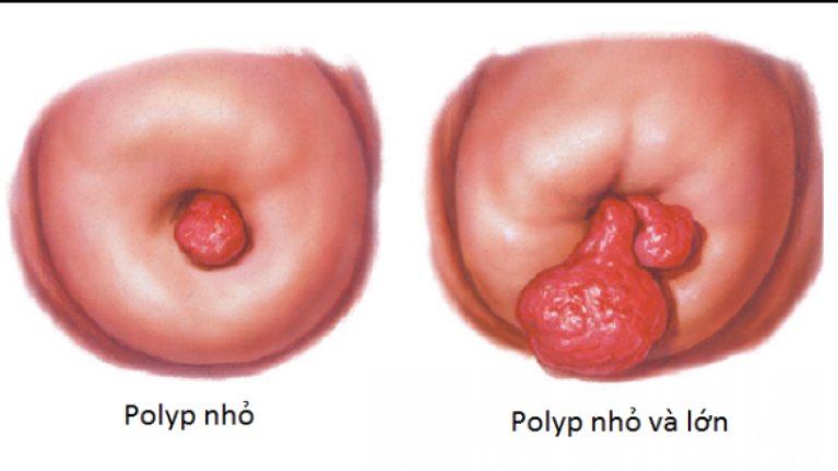 Polyp lòng tử cung chống chỉ định siêu âm bơm nước buồng tử cung