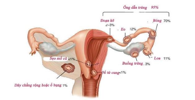 Tình trạng buồng tử cung bị dính có thể khiến phụ nữ mang thai ngoài tử cung cực nguy hiểm