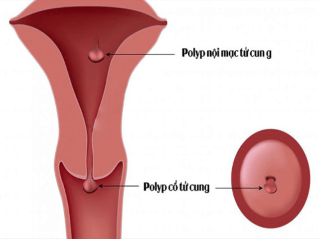 Polyp cổ tử cung