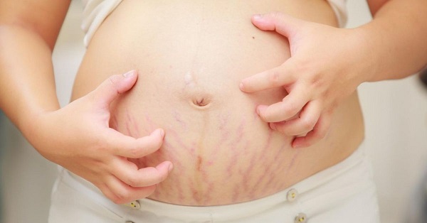 Tăng cân quá nhanh trong thai kỳ là nguyên nhân hàng đầu gây ra rạn da ở mẹ bầu