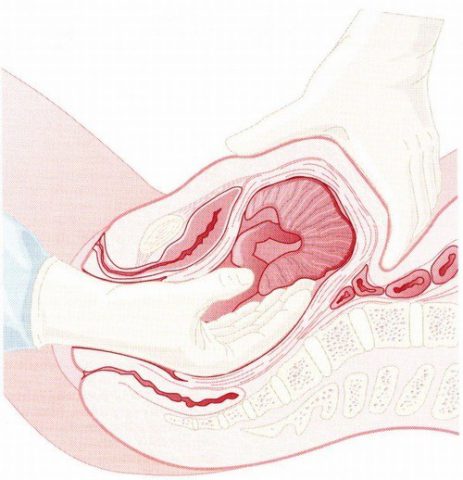 Rách cổ tử cung, âm đạo là những sang chấn thường gặp trong sinh thường, trường hợp thai to, sinh khó.