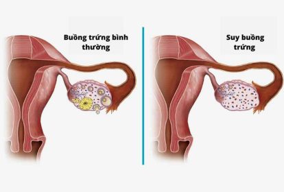 Chỉ điểm những dấu hiệu tiền mãn kinh sớm ở chị em phụ nữ