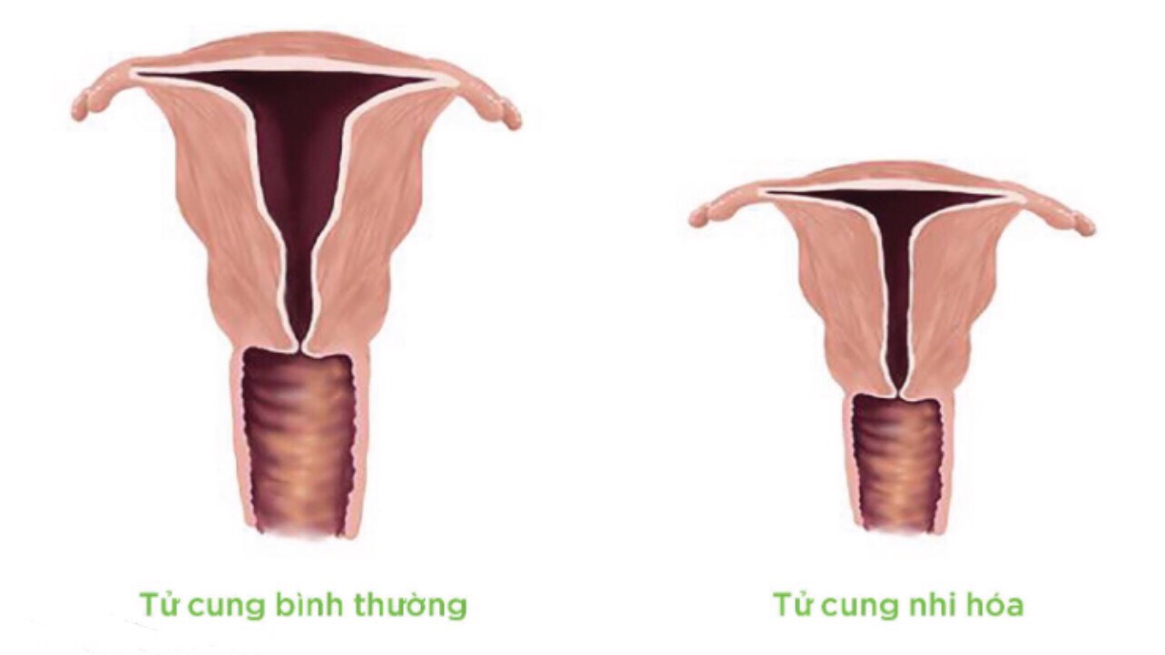 Tử cung nhi hóa là một trong những bất thường sinh dục ảnh hưởng đến khả năng mang thai và làm mẹ của người phụ nữ