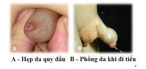 Hẹp bao quy đầu