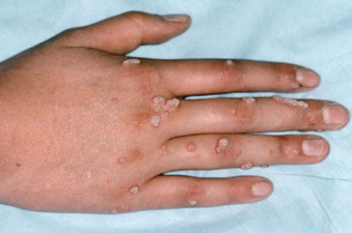 Mụn cơm thường xuất hiện ở mu bàn tay, trên các ngón tay