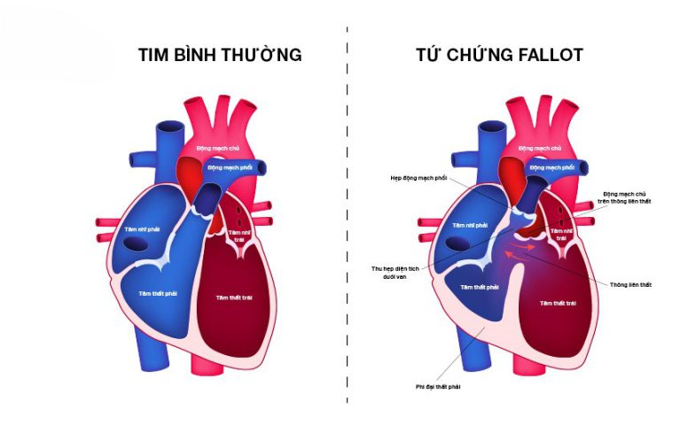 Bệnh tim Fallot 4 là bệnh tim mà trẻ sơ sinh thường mắc phải