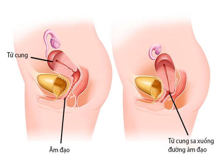 Sa tử cung kéo theo sa trực tràng khiến sản phụ bị táo bón nghiêm trọng hơn cả khi mang thai