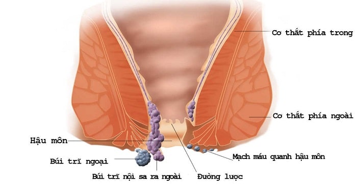 Bị trĩ khi mang thai 3 tháng cuối