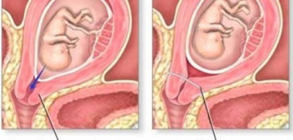 Hở eo cổ tử cung là nguyên nhân hàng đầu gây sảy thai liên tiếp ở phụ nữ