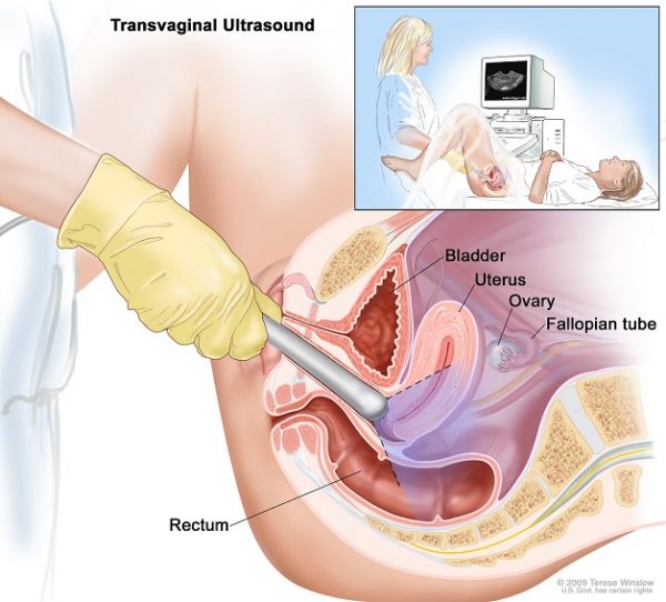 Siêu âm đầu dò âm đạo phát hiện có thai sớm, loại trừ nguy cơ chửa ngoài tử cung