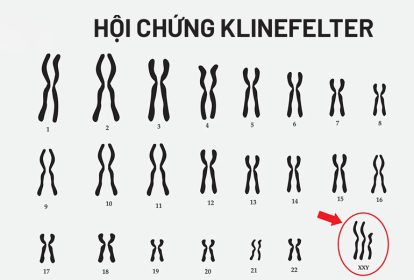 Thừa một nhiễm sắc thể X dẫn đến hội chứng Klinefelter