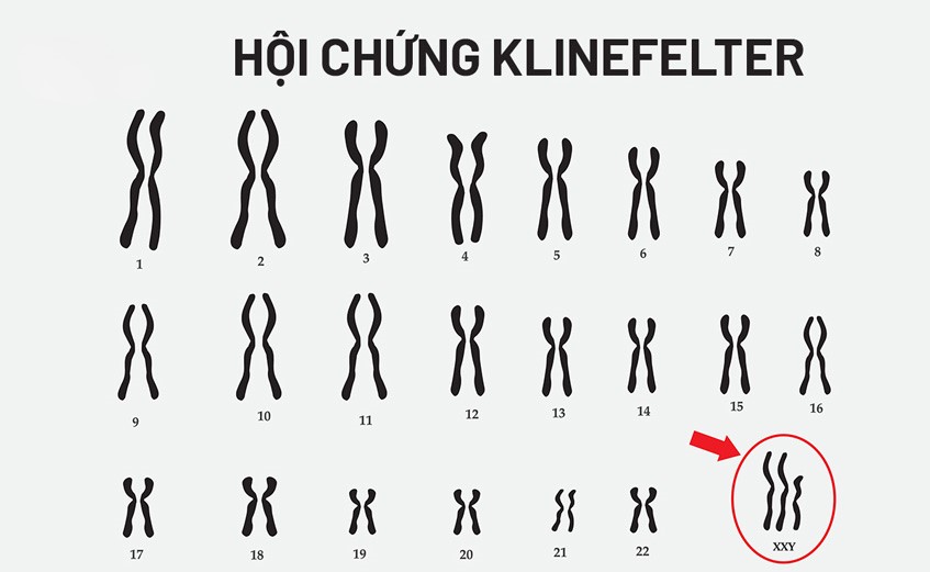 Thừa một nhiễm sắc thể X dẫn đến hội chứng Klinefelter