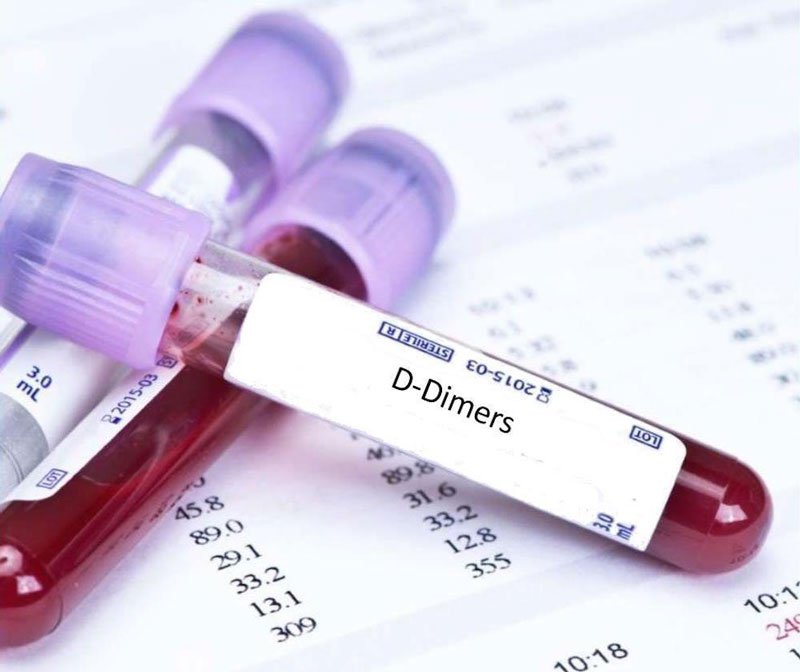 Định lượng nồng độ D-Dimer trong máu giúp xác định tình trạng rối loạn đông máu