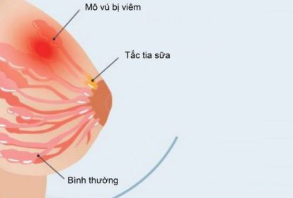 Viêm vú là tình trạng viêm mô vú, thường gặp do tắc ống dẫn sữa