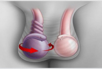 Đau tinh hoàn có thể là triệu chứng bệnh xoắn tinh hoàn