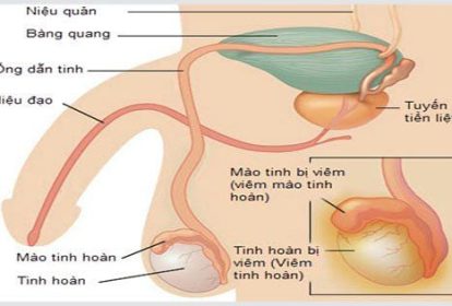 Viêm tinh hoàn