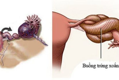 Xoắn buồng trứng là một trong những cấp cứu phụ khoa phổ biến
