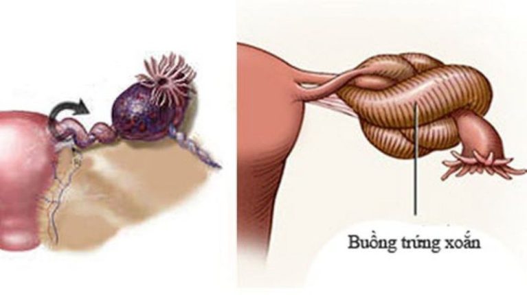 Xoắn buồng trứng là một trong những cấp cứu phụ khoa phổ biến