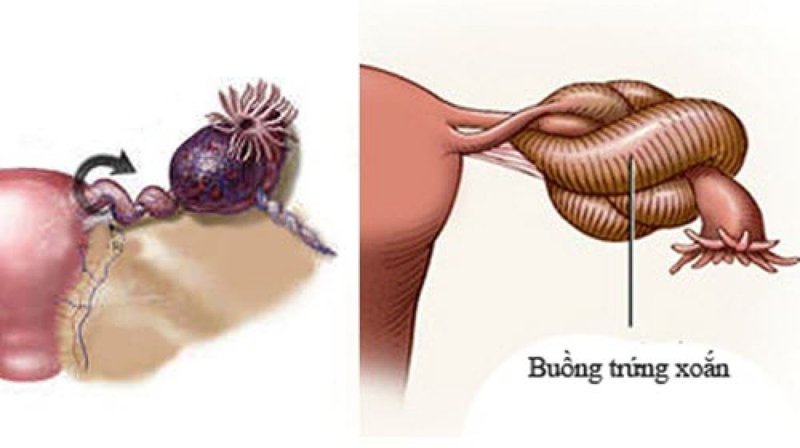 Xoắn buồng trứng là một trong những cấp cứu phụ khoa phổ biến