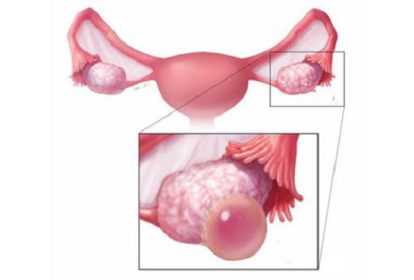 Nang hoàng thể là bệnh khá phổ biến ở phụ nữ