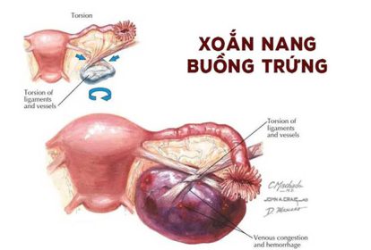 U nang buồng trứng xoắn là biến chứng nguy hiểm, tiềm ẩn nhiều vấn đề ảnh hưởng đến chức năng, hoạt động của buồng trứng