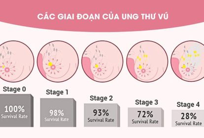 Các giai đoạn của ung thư vú hiện nay