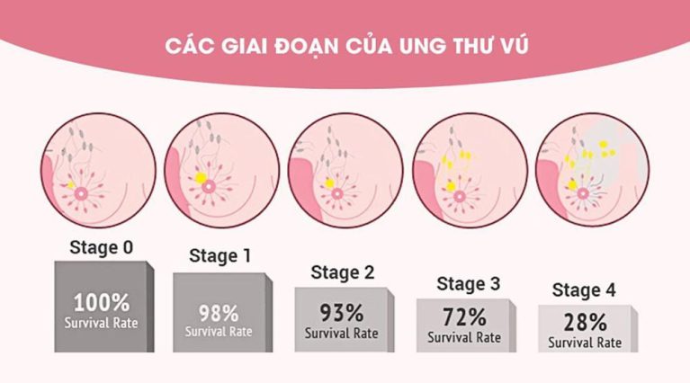 Các giai đoạn của ung thư vú hiện nay