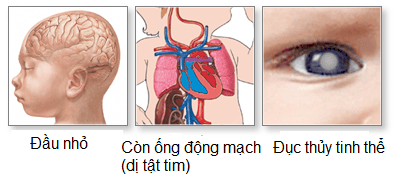 Một số bệnh do biến chứng Rubella gây ra.