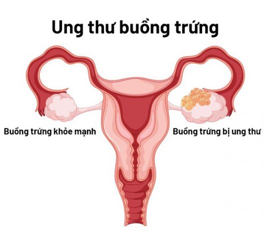 Các tế bào bất thường phát triển thành khối u ở một hoặc cả hai buồng trứng