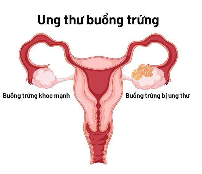 Các tế bào bất thường phát triển thành khối u ở một hoặc cả hai buồng trứng