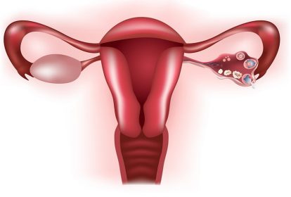 Tắc vòi trứng là tình trạng bít hẹp đường dẫn trứng trứng tới làm tổ tại tử cung