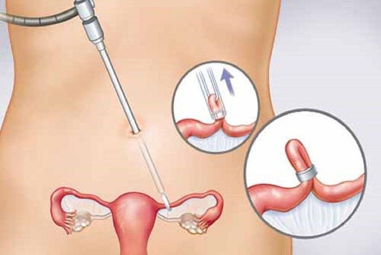 Phẫu thuật nội soi triệt sản nữ cũng có thể gặp một số tai biến