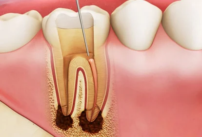 Lấy tủy răng không ảnh hưởng đến thai nhi nếu được thực hiện đúng cách, đúng thời điểm, bác sĩ tay nghề cao