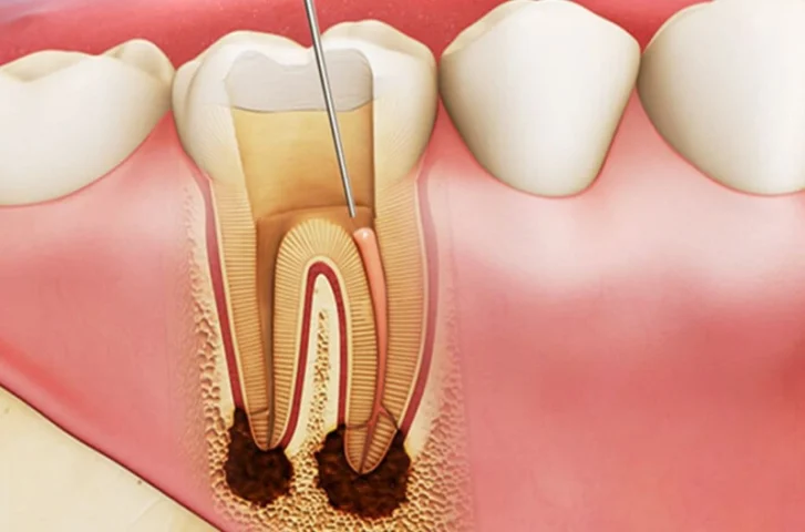 Lấy tủy răng không ảnh hưởng đến thai nhi nếu được thực hiện đúng cách, đúng thời điểm, bác sĩ tay nghề cao