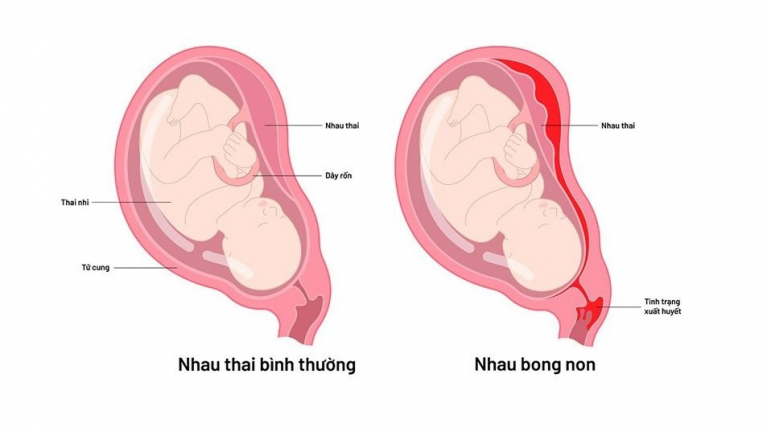 Nhau bong non hay rau bong non (Placental Abruption) là tai biến sản khoa nguy hiểm