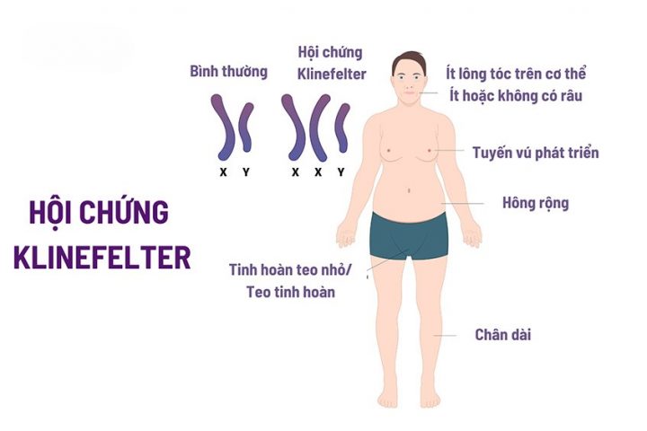 Đặc điểm nam giới mắc hội chứng Klinefelter