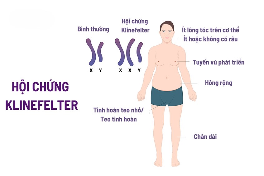 Đặc điểm nam giới mắc hội chứng Klinefelter