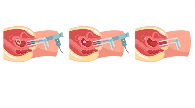 Phương pháp phá thai bằng hút chân không