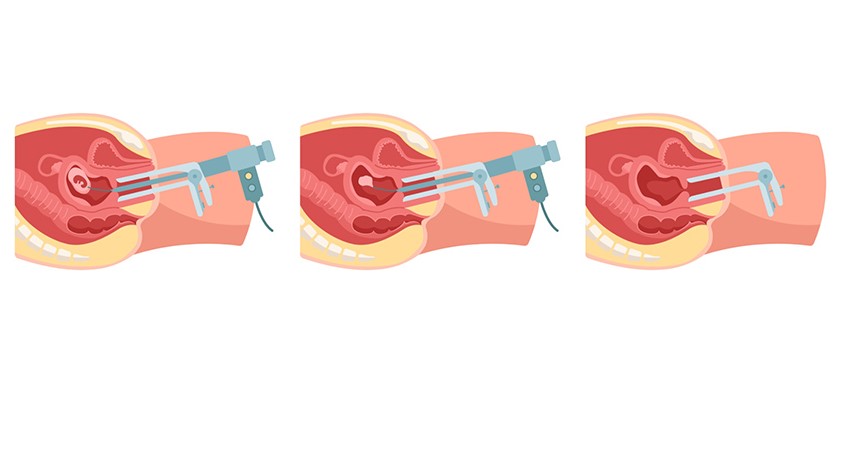 Phương pháp phá thai bằng hút chân không