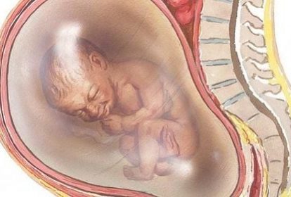 Đa ối là hiện tượng tích tụ dư thừa nước ối